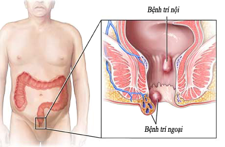 Bệnh trĩ và viêm đường ruột