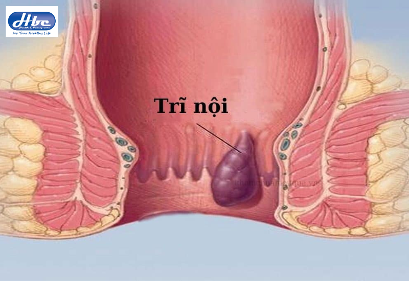 Bệnh trĩ nội có nguy hiểm không?