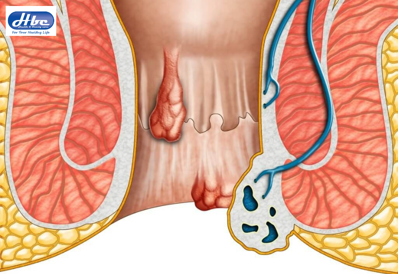 Bệnh trĩ ngoại có nguy hiểm không?