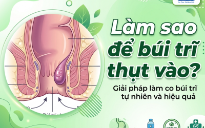 Làm sao để búi trĩ thụt vào? Cách xử lý hiệu quả tại nhà